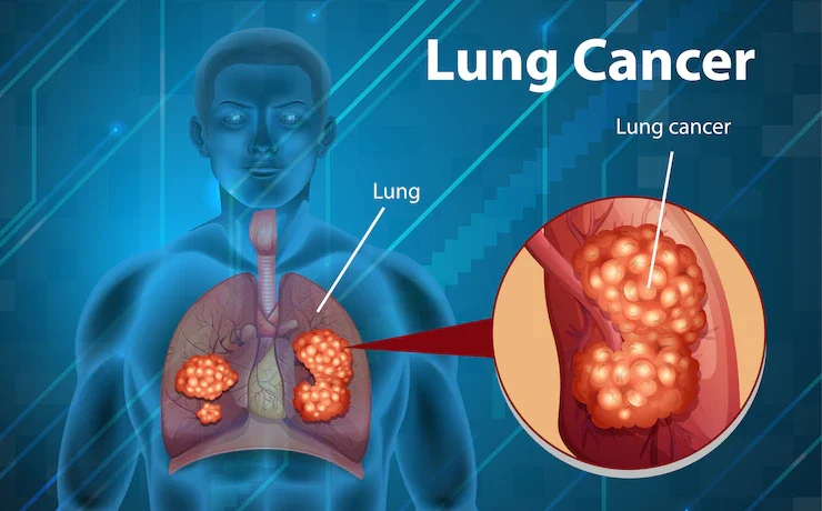 What is lung cancer?