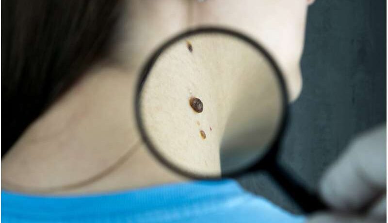 Gaps in skin cancer care for older adults, rural residents, and others highlighted in review